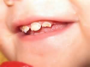CARIES IS A DISEASE BUT IT IS PREVENTABLE!! IT IS AN INFECTION AND IS INFECTIOUS!! The mouth is sterile at birth.