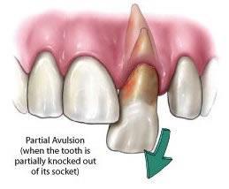 Avulsed teeth Knocked-Out (Avulsed) Teeth: If a tooth is completely knocked out of your mouth, time is of the essence.