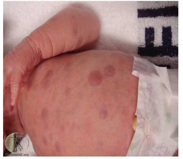 Blue Berry Muffin Baby Syndrome 19 MANAGEMENT Figure 3 CONCLUSIONS Some like syphilis and toxoplasmosis can be treated with antibiotics.