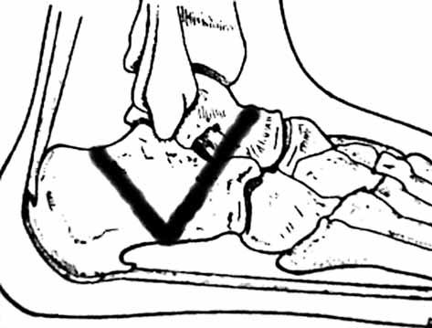 COMPLEX FOOT DEFORMITIES 587 the surgeon to tune the rate and direction of the correction (7, 11, 12).