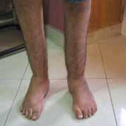 foot deformities treated by Ilizarov