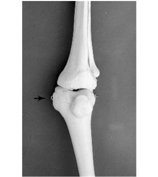 Recurvatum Quadriceps weakness Knee Ankle Foot Orthosis Genu valgum 3 point force system