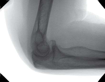 Elbow rests flat on detector. Extremity runs parallel to detector.