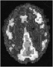 A Tale of Two Brains Murderer s Brain Normal Brain Neuroanatomy Frontal Lobe Functions Planning Problem