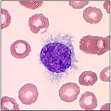 Hairy cell leukemia Surface of cells look hairy under microscope Called leukemia as cancerous lymphocytes can be found in