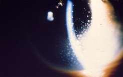 AC: Shallow anticipate iris bombe, Intumescent cataract Deep possible luxated lens held by adhesions,