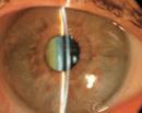 Dense NS narrows angles and wide dilation can lead to angle closure