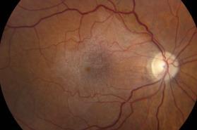 Risk of Retinal Tears May Require Consultation With Retina
