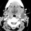 Branchial Cleft Cysts Type II 95% of all branchial cleft lesions Cystic mass at the anterolateral border of SCM Type 1 Branchial Cleft Cyst Extends from external auditory canal (EAC) through the