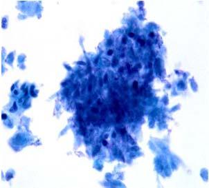 HPV and Prognosis in Oropharyngeal Cancer HPV may be a favorable prognostic factor (Gillison et al, 2000;Mellin et al., 2000) Mellin et al.
