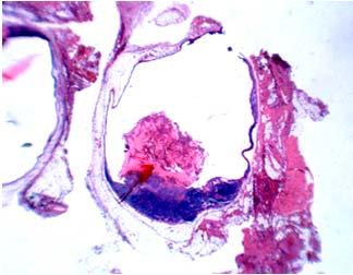 carcinoma  neck cystic mass Histology
