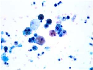 variant of papillary carcinoma, ** = metastatic well-differentiated follicular derived carcinoma *** = poorly differentiated