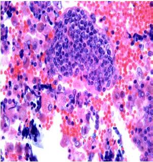 32 year old man with bilateral parotid gland masses HIV + Lymphoepithelial Cyst Warthin s Tumor Primarily occurs