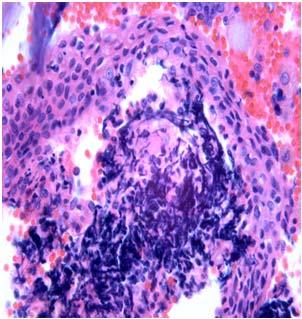 remnants entrapped within glandular lymphoid tissue Clinical features: 50 79 year old Common in men Bilateral