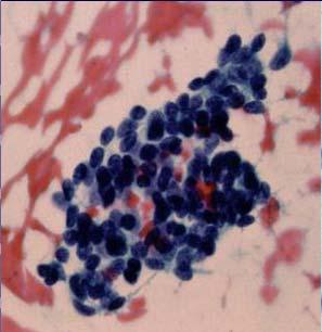 Can not distinguish from malignant basaloid tumors Minimal cytoplasm