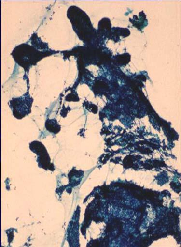 Sample Cytologic Diagnosis DX: Cellular neoplasm with basaloid cell features, see