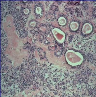 Pleomorphic Adenoma 75% of major salivary gland tumors Female, 30-40 years