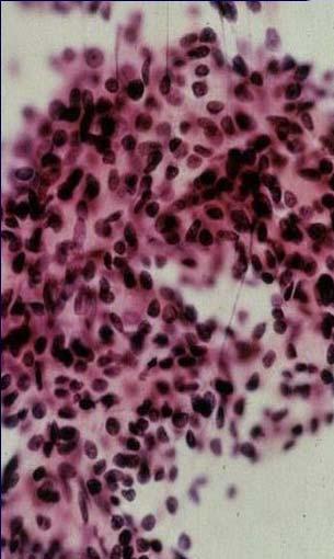 LG Mucoepidermoid Carcinoma Cytology