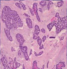 Case #1: Parotid mass, 56 yo male What is your Diagnosis? A. Pleomorphic adenoma B.