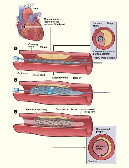 Current Treatments for Coronary Artery Disease Leading cause of death in many developed countries Treatment evolution Open heart surgery CABG Late 1970s balloon angioplasty Early 1990s bare metal