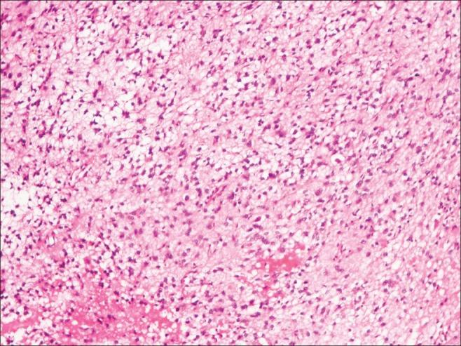 Figure 4 Pilocytic astrocytoma composed of glial cells with small cytoplasmic processes forming loose fibrillary matrix (H and E,