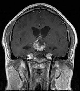 sis of malignantly transformed craniopharyngioma is poor and because of its low incidence rate, there is insufficient evidence for various treatment modalities.