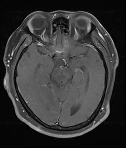 Malignant Transformation of Craniopharyngioma without Radiation Therapy Jeong