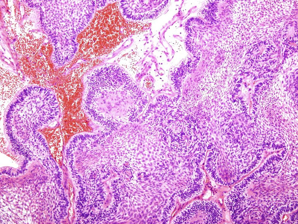 Malignant craniopharyngiomas are presumably derived from the remnants of Rathke