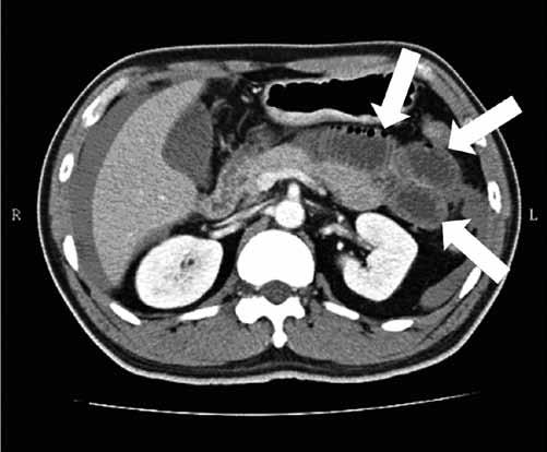 Figure shows a large solid tumor in the pelvic cavity surrounded by high attenuation blood in the peritoneal cavity, indicating tumor rupture.