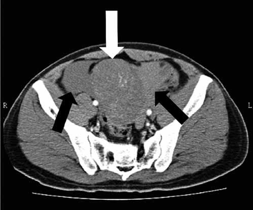 Gastrointestinal stromal tumor presenting as hemoperitoneum 295 Conclusion Figure.