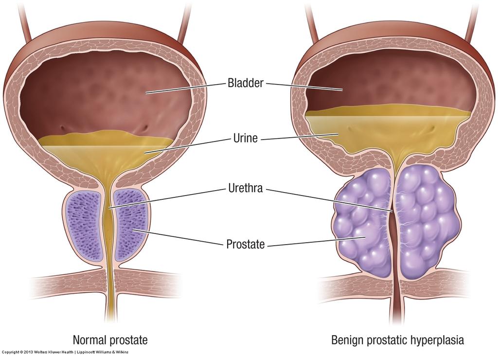 Disorders of the Male Reproductive System" Benign prostatic hyperplasia (AKA: BPH) Prostate gland of a mature man begins to