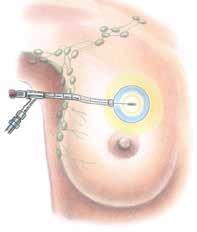 FIGURE 1 TEMPORARY BRACHYTHERAPY Breast Example Temporary radioactive source (seeds) is placed in the breast through a catheter into a device.