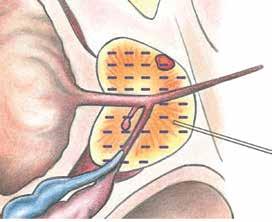 Radioactive seeds Tumor Prostate Radioactive source Catheter Balloon (fills cavity left by lumpectomy) Bladder Urethra Implant needle Rectum Patient Resource LLC Vas deferens Seminal vesicle Patient