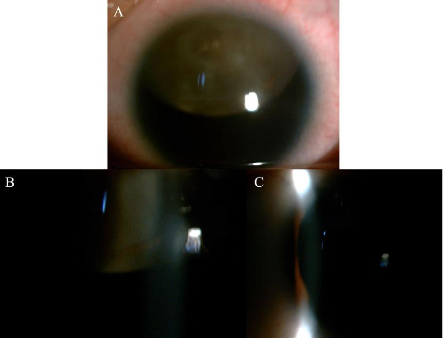 F. He et al. 13332 Figure 3. Photographs of the iris and lens of the affected family members. A. Superior subluxation of the lens; B. Cataract; C. Aniridia. Figure 4.