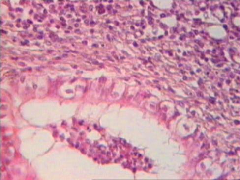 Liigveresus ja turse. Hematoksüliin ja eosiin. Suurendus 100 x Figure 5. Lung of the 30 days old calf. Polymorphonuclear leucocytes, detached epithelial cells and mucin in the bronchioles and alveoli.