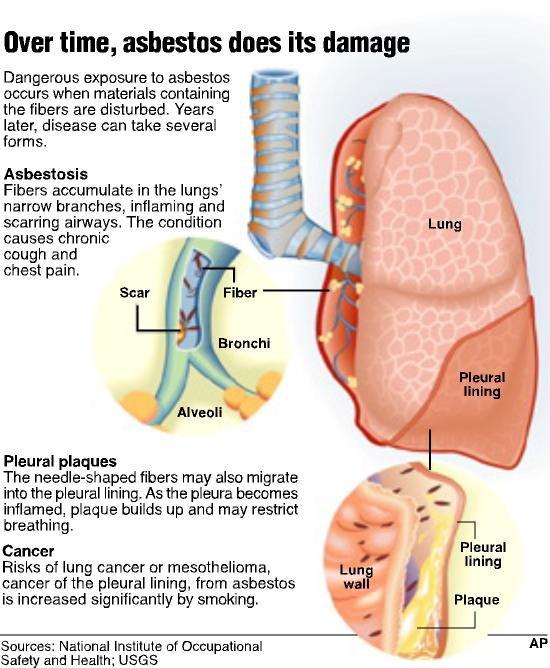 Examples of inorganic dust diseases Asbestosis Asbestosis is caused by the