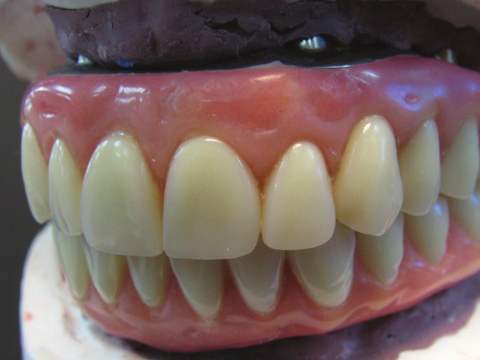 The gingival base was then invested and processed in a heat cure resin (SR Ivocap Injection System, Ivoclar Vivadent).