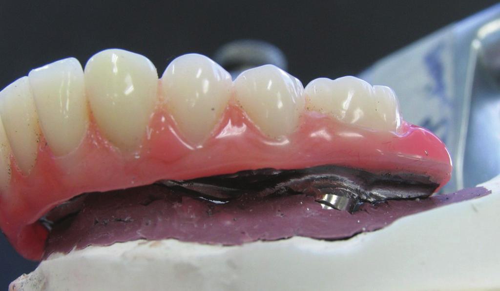 bevel from the labial and buccal surfaces to the residual ridge.