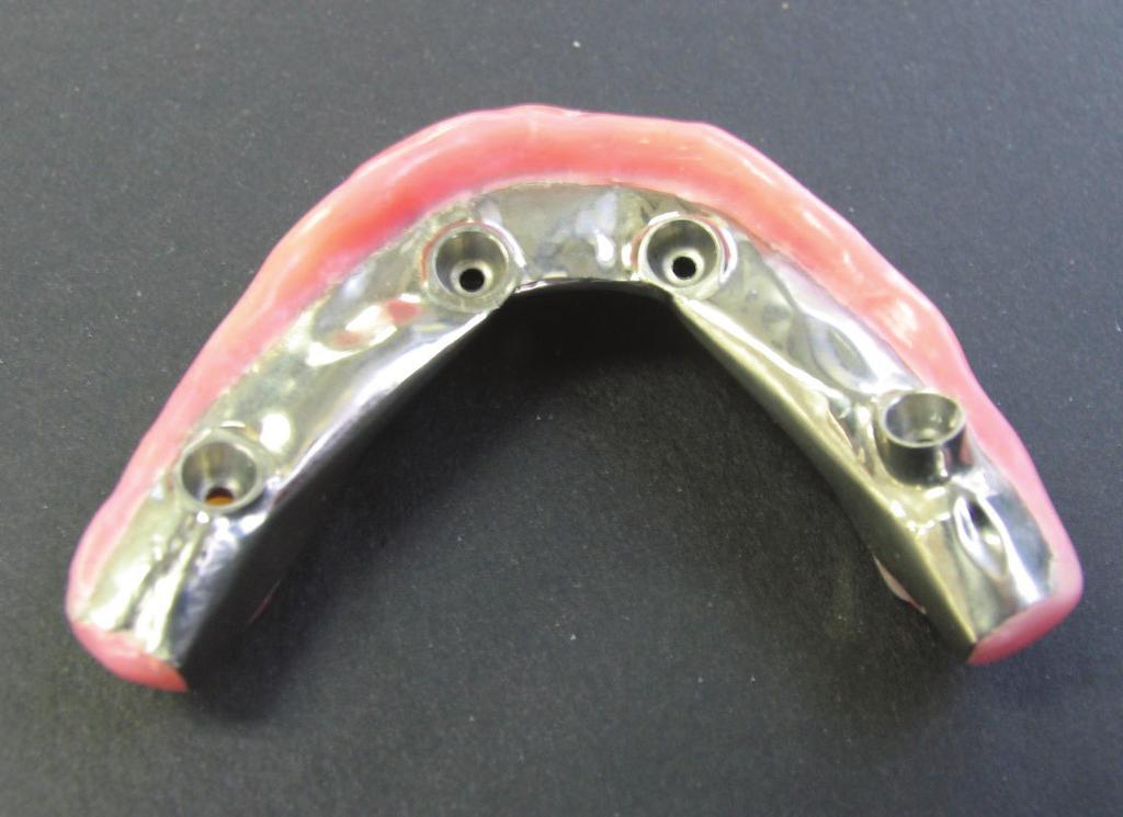 To achieve a proper contour, the titanium intaglio needed to be cut back to allow for a beveled tissue-to-tooth emergence profile, leaving the
