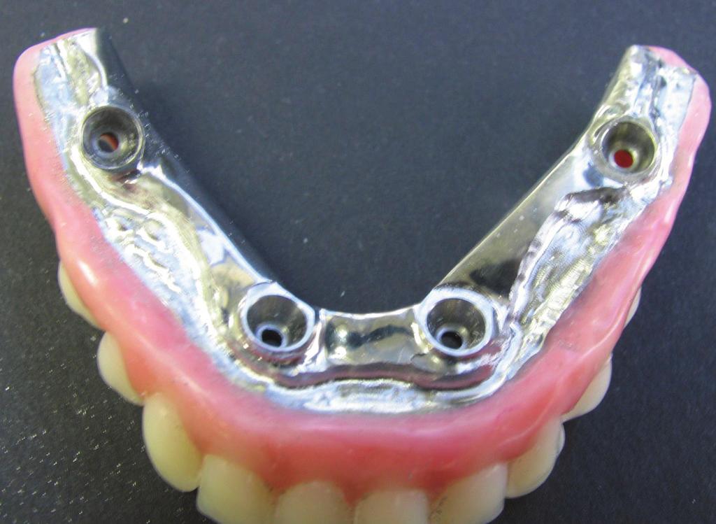 The maxillary and mandibular titanium intaglio surfaces were cut back to the crest of the residual ridge to recreate a new external finish line.