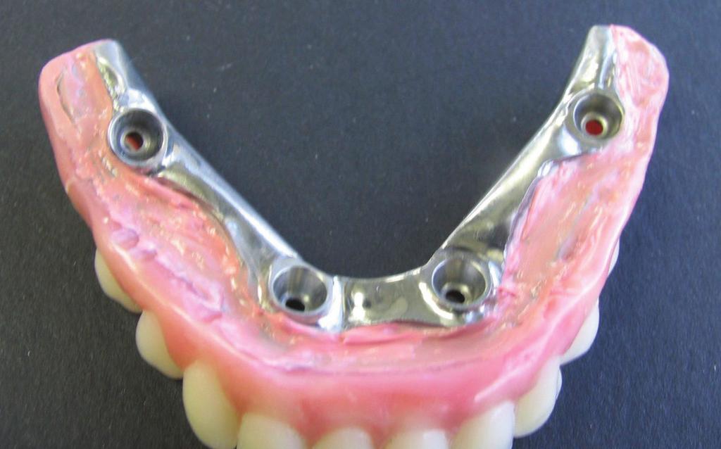 Maxillary and mandibular acrylic processed bars with the problem of over-extended labial and buccal external finish lines. Fig 7.