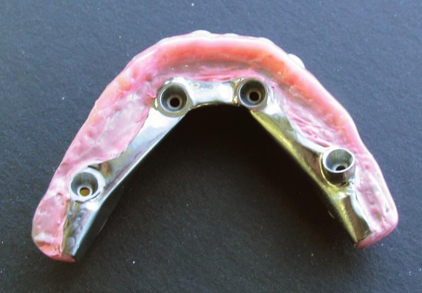 Intaglio view of the mandibular before the metal was cut back. Fig 10.