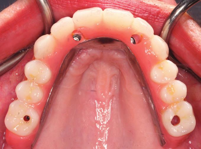 Figure 15 and Figure 16 show the right and left buccal view of composite-to-ridge relation. It is very important to allow space for Super Floss orthodontic floss (Oral-B, www.oralb.