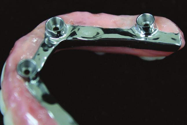 An intaglio view of the maxillary right side 20 21 22 showing re-contoured