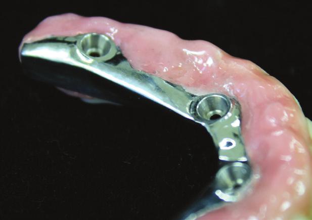 An intaglio view of the mandibular right side showing re-contoured metal and