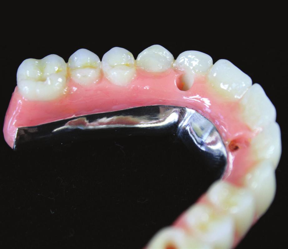 A lingual view of the finished maxillary acrylic and composite