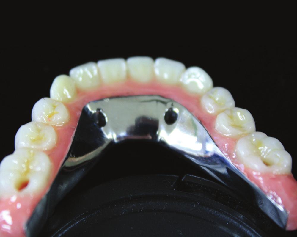 A lingual view of the finished mandibular acrylic and composite