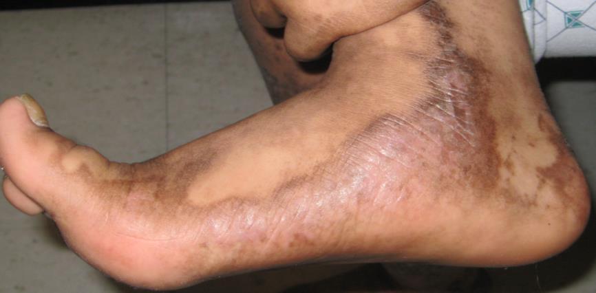 Clinical Signs/Symptoms of Cutaneous Lichen Planus Characterized by the six Ps : Pruritic Purple Polygonal Planar Papules Plaques Numerous patterns and sites; common on wrists, forearms, legs,
