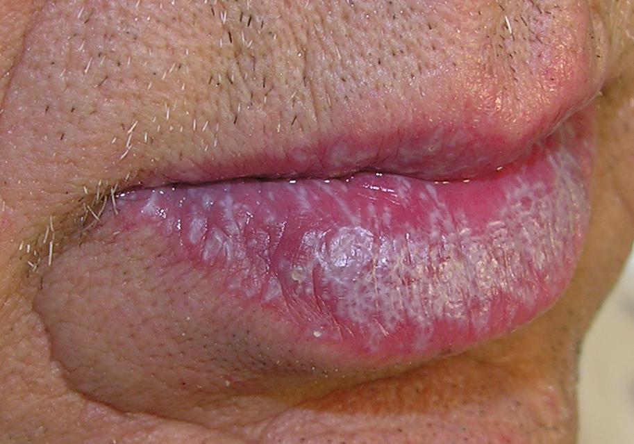 Clinical Signs/Symptoms of Cutaneous Lichen Planus New lesions are pinkwhite, but over time develop a distinct purple color with a waxy luster Lesions may coalesce to form plaques Close examination