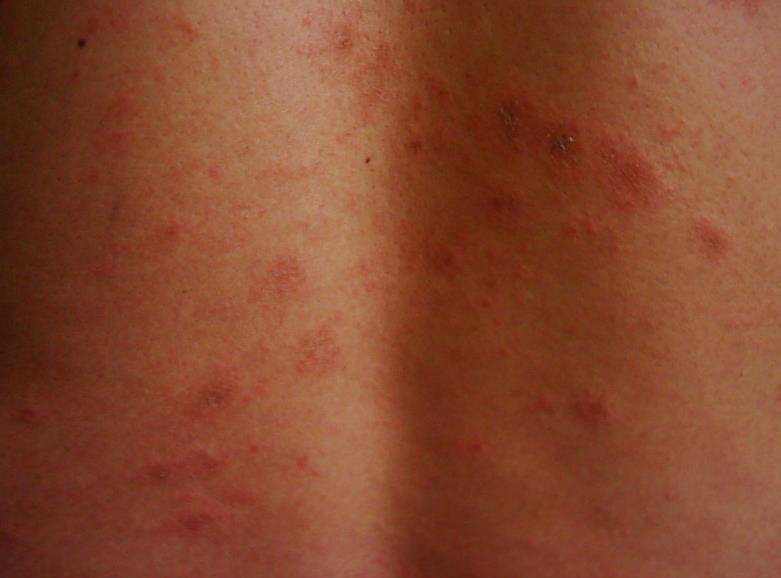 Clinical Signs/Symptoms of Pityriasis Rosea 7 to 14 days after the herald plaque appears, crops of 1- to 2-cm oval, raised plaques appear Salmon-coloured in people with light skin and hyper- or